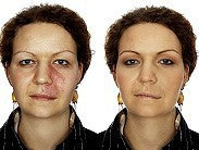 Dermacolor Camouflage Fluid Make Up Anwendungsbeispiel